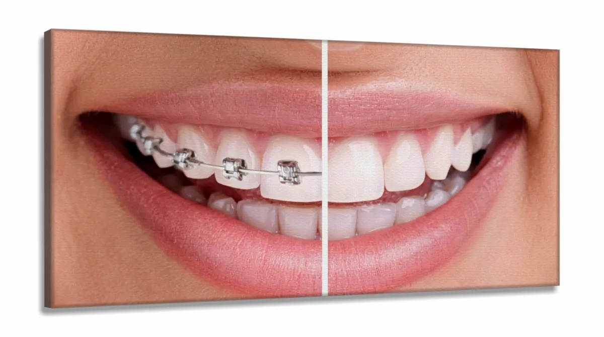 Quadro Decorativo Dentista Aparelho em Tecido Canvas 130x60 Imagem
