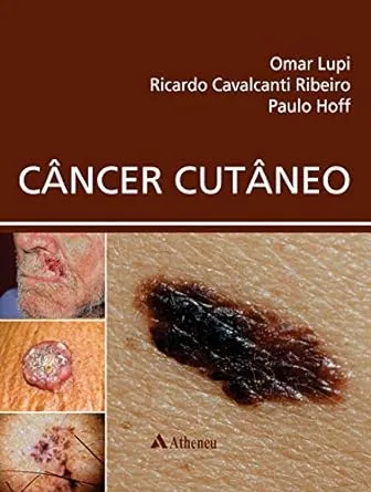 Câncer Cutâneo